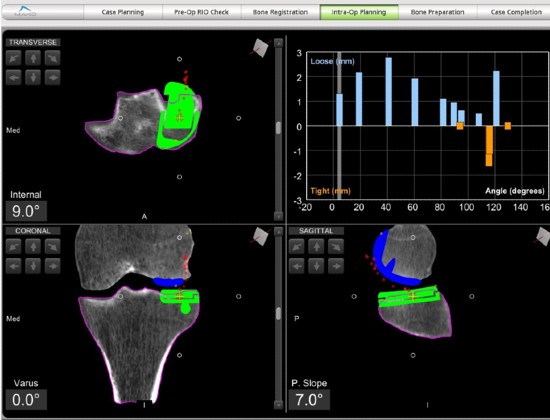 Planning a partial knee replacement